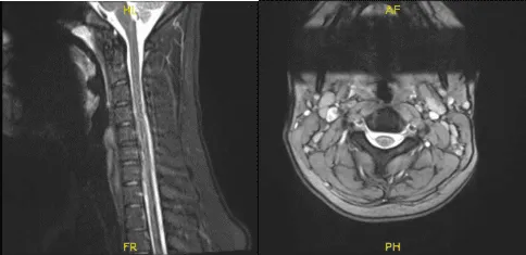 MRI-3T Columna cervical sin contraste