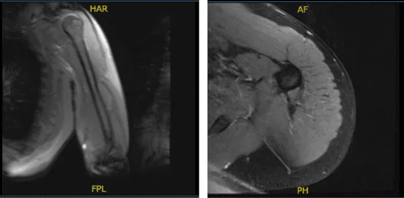 MRI-3T Left Arm Non-contrast