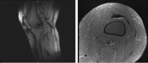 MRI-3T Rodilla Izquierda sin contraste