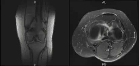 MRI-3T Left Knee Non-contrast