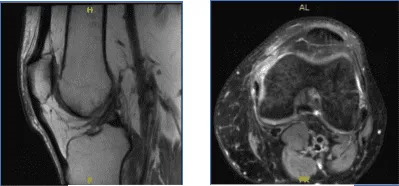 MRI-3T Left Knee Non-contrast
