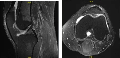 MRI-3T Rodilla izquierda sin contraste