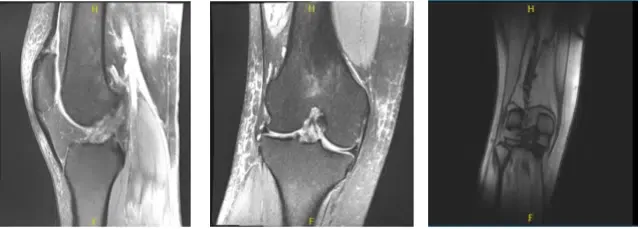 MRI-3T Right Knee non-contrast