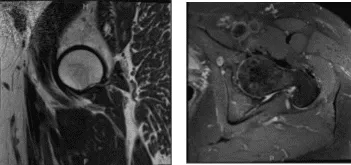 MRI-3T left hip non-contrast
