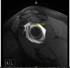Artrograma MRI-3T en hombro izquierdo