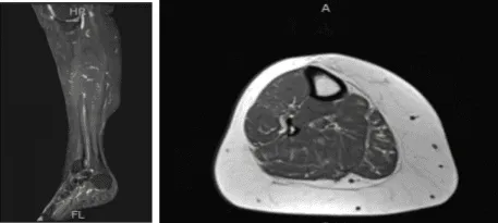 MRI- Right Calf Non-contrast