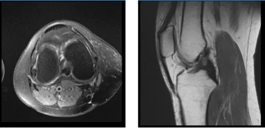 Resonancia magnética de rodilla derecha sin contraste