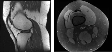 MRI Right Knee Non-contrast