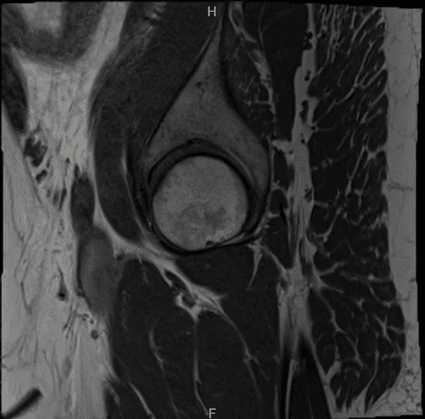 MRI Right hip non-contrast