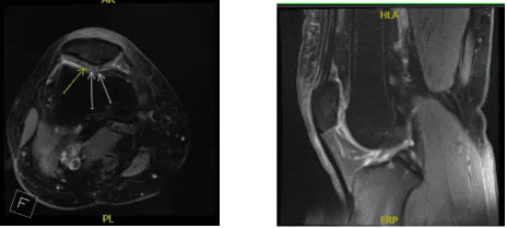 Resonancia magnética de rodilla derecha sin contraste
