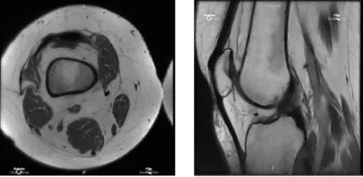 MRI Right knee non-contrast