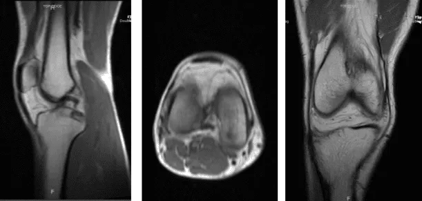 MRI Right knee non-contrast
