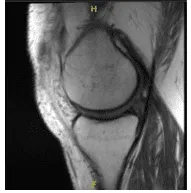 MRI presented to post operative visit, no visibility of the cyst