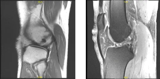 MRI right knee non-contrast