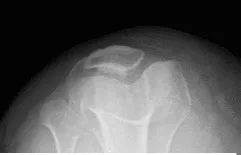 Horizonte de Patella