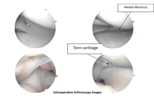 Imágenes de artroscopia intraoperatoria