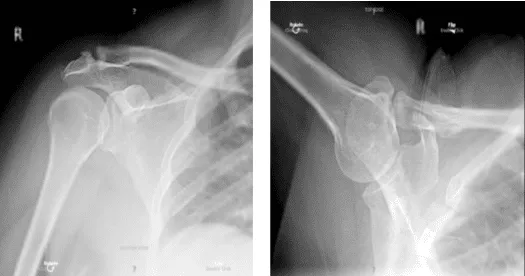 X-ray bilateral shoulders