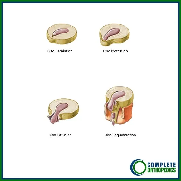 Disc Rupture Classification Illustrated