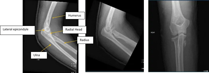 Figure 1. AP Oblique and Flexion Lateral Projection of Right Elbow