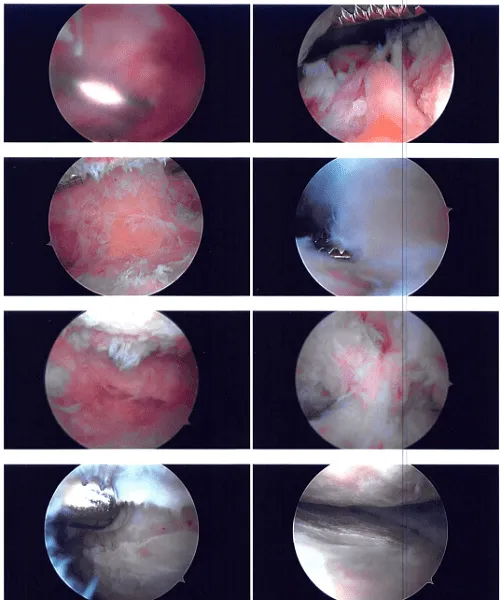 Foto intraoperatoria