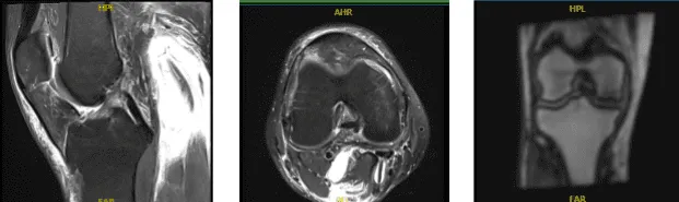 MRI Right Knee Non-contrast