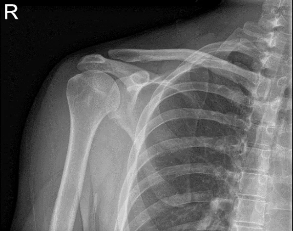 Bilateral Shoulder X-ray AP External and AP Internal