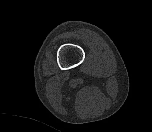 CT-Right Knee Non-contrast