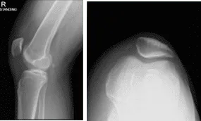 Radiografía de la rodilla derecha con rótula