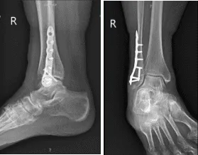X-ray Right ankle minimum 3 views