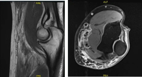 Resonancia magnética 3T Codo izquierdo sin contraste