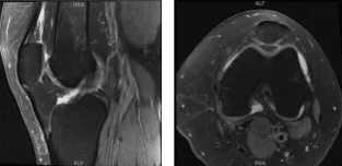 MRI-3 Left knee non-contrast