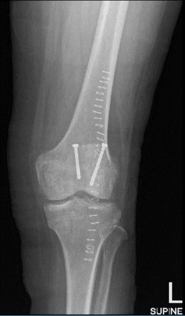 Radiografía de rodilla izquierda AP y lateral
