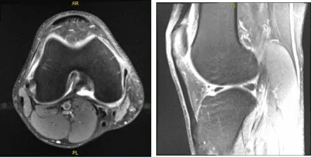 MRI-3T Rodilla derecha sin contraste