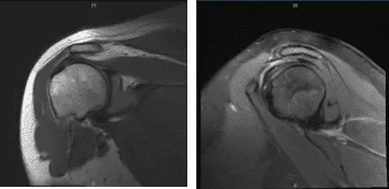 MRI-3T Left Shoulder non-contrast