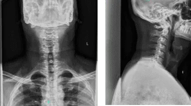 Radiografía: 2 o 3 vistas de la columna cervical