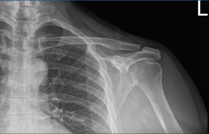 MRI of left shoulder