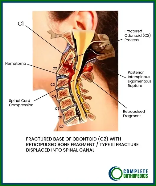  Fractured Base of Odontoid (C2) with Retropulsed Bone Fragment (Type III Fracture Displaced into Spinal Canal)