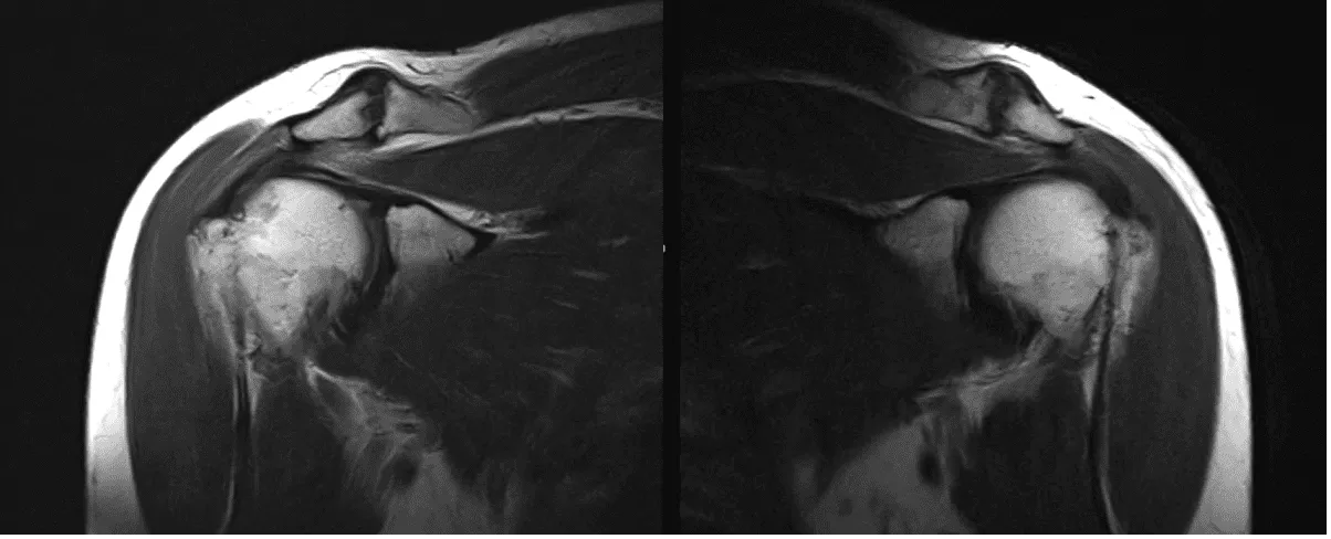 MRI Left Shoulder Non-contrast