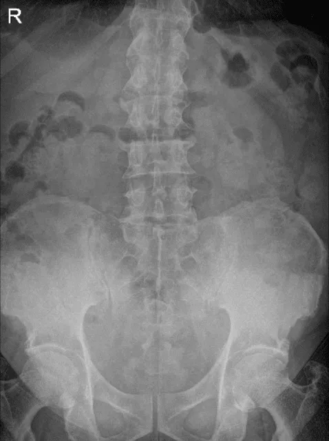 LS Spine X-ray Flex/Ext sin oblicuos