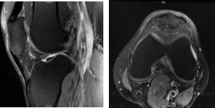 MRI-3T Left Knee non-contrast