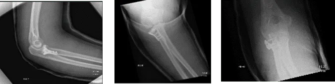 Figure 2. Image of Elbow with 3 cortical screws