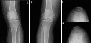 Radiografía de rodilla izquierda y derecha con rótula