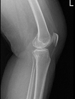 Left Knee X-ray AP and Lateral with Oblique 3 views