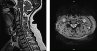 Resonancia magnética de columna cervical sin contraste
