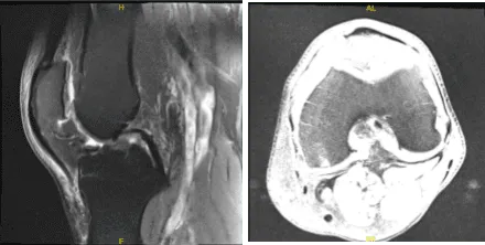 MRI-3T Left knee non-contrast