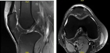 MRI-3t Rodilla derecha sin contraste