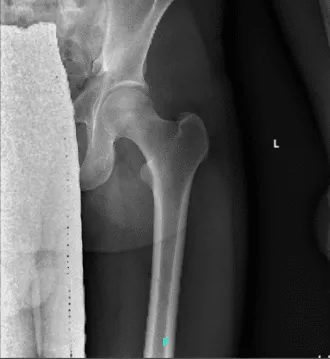 Radiografía 2-3 vistas de la cadera izquierda  