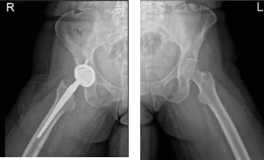 Cadera bilateral con pelvis 3 o 4 más vista