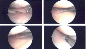 Intraoperative Arthroscopy Images