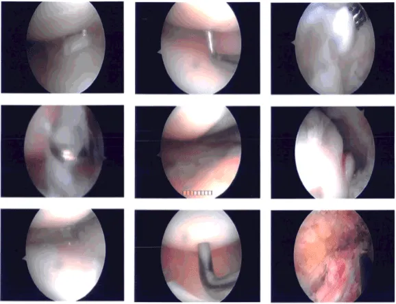 Intraoperative photo